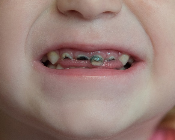 Closeup of child's teeth with cavities