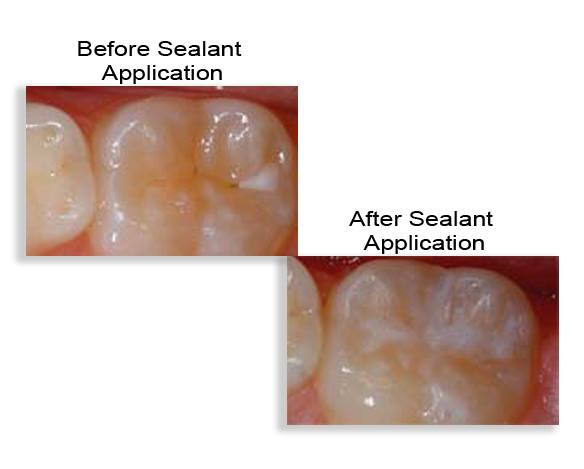 Tooth before and after dental sealant placement