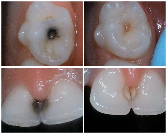 Tooth throughout the silver diamine fluoride treatment process