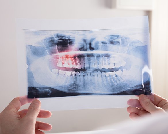 X-ray of smile with developing wisdom teeth