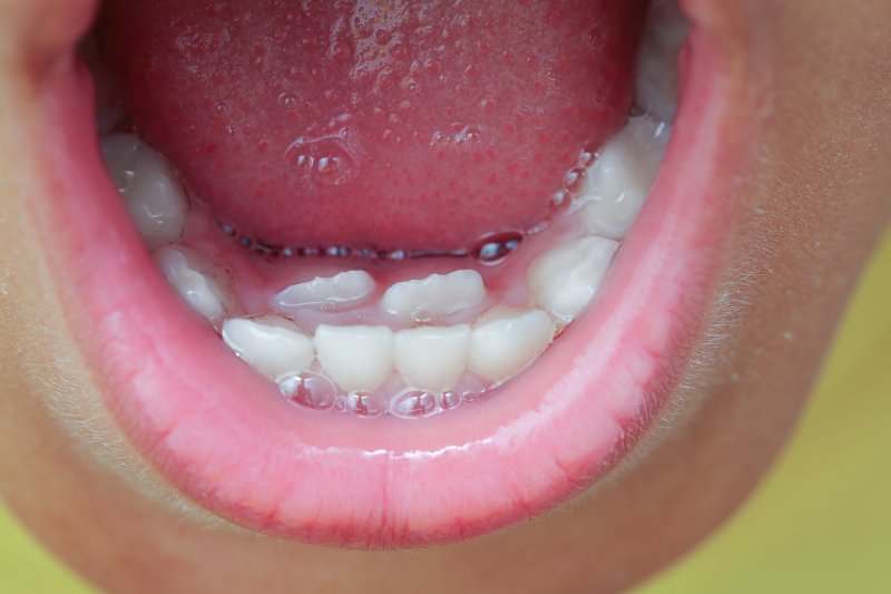 a up-close view of a child who has what is known as “shark teeth” in Coppell